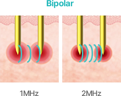 Bipolar